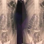 Dokter bedah temukan serangga hidup di usus pasien: penyebab tak terduga yang mengungkap misteri medis baru