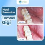 Fenomena ‘tambal gigi online’ memicu kehebohan, kini Perhimpunan Dokter Gigi resmi mengeluarkan pernyataan kritis