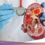 Jepang Catat Kenaikan Kasus Gagal Ginjal Akut pada Usia Muda; Penelitian Ungkap Faktor Risiko dan Upaya Pencegahan Baru